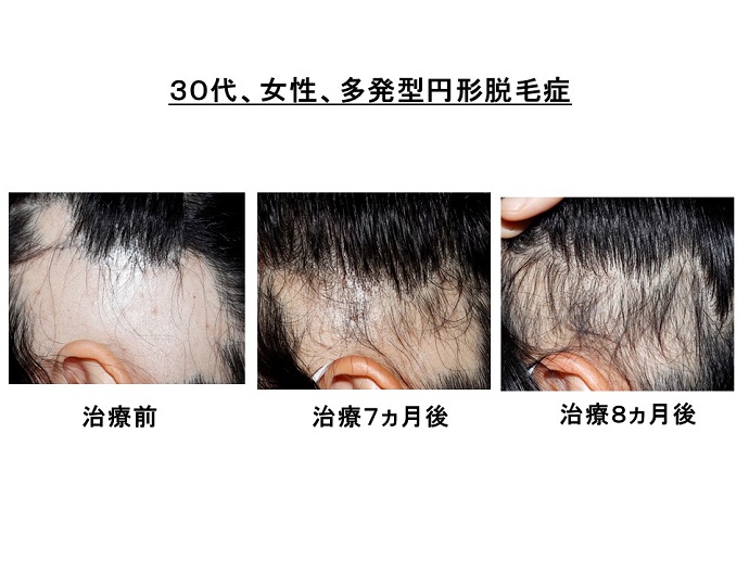 円形脱毛症　病院